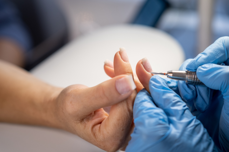 Les Champignons des Ongles : Causes, Symptômes, Complications et Traitements Naturels